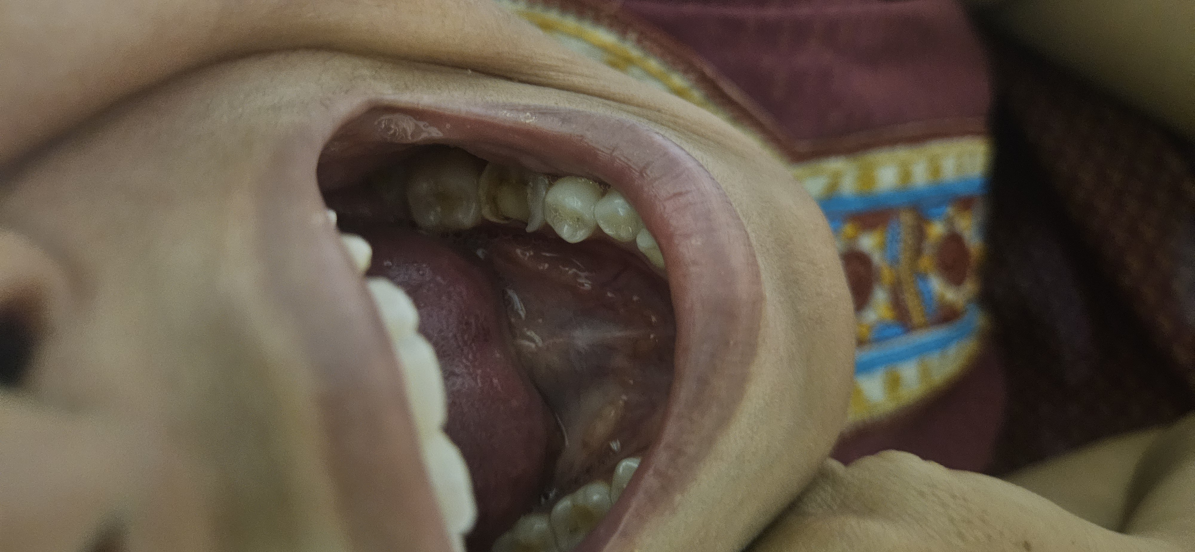 Dental treatment after — patient 2 smile transformation at Durge Dental Mancherial