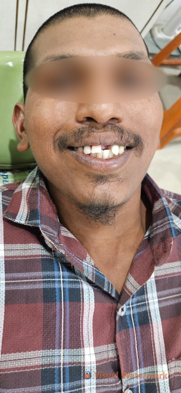Dental treatment before — patient 1 at Durge Dental Clinic Mancherial